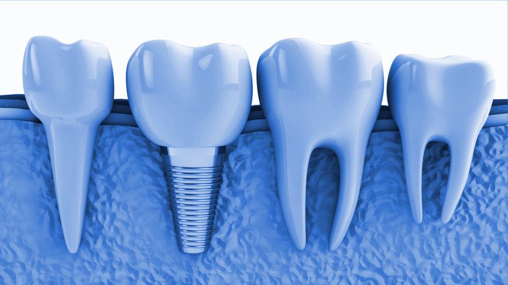 Implantes dentales financiados